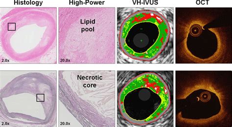 Direct Comparison Of Virtual Histology Intravascular Ultrasound And