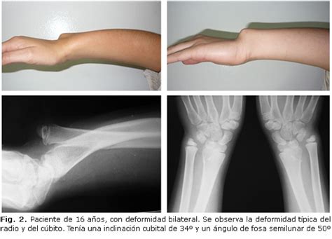 Enfermedades raras: Deformidad de Madelung