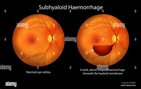 Illustration Of A Subhyaloid Haemorrhage On The Retina As Observed