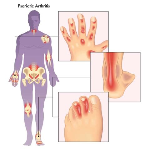 Psoriatic Arthritis What Is Psoriatic Arthritis Signs Symptoms Causes Risk Factors And