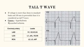 Abnormalities of t wave | PPT