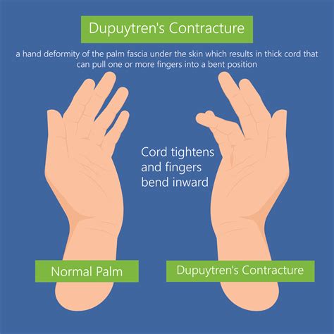 Dupuytren S Contracture Treatment In Sydney