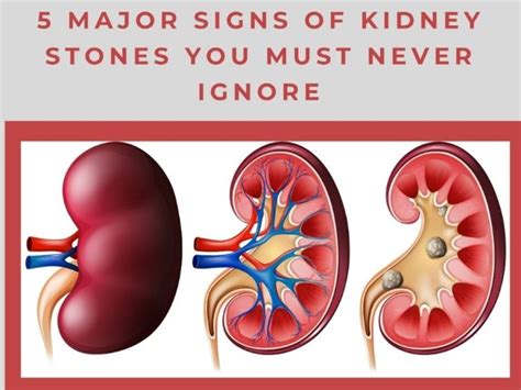 Kidney Stones Pain Treatment