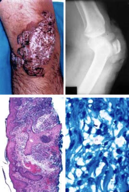 Tuberculosis Verrucosa Cutis Mayo Clinic Proceedings