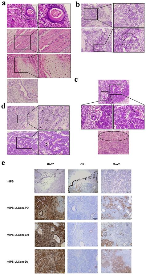 Histopathological Observation Of The Tumors Formed By The Cscs Benign