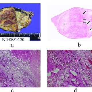 Pathological Findings A Macroscopic Findings Of The Tumor A