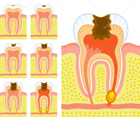 Internal Structure Of Tooth Decay And Caries — Stock Vector