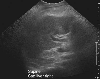 Diffuse Liver Disease | Radiology Key