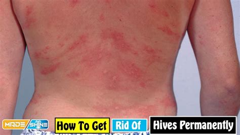 How To Get Rid Of Hives Permanently Home Remedies For Hives Symptoms