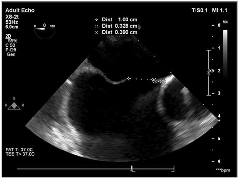 Case Report Of An Atrial Septal Defect With Negative Transthoracic