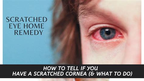 Scratched Eye Home Remedy HOW TO TELL IF YOU HAVE A SCRATCHED CORNEA