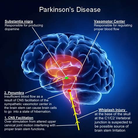 10 best images about Parkinson's Disease on Pinterest | Car crash ...