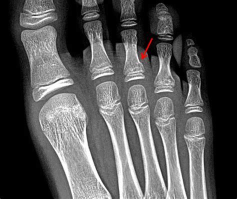 Salter Harris Phalanx Fracture