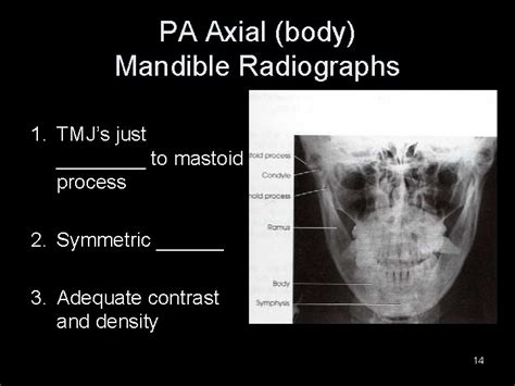 Mandible TMJ Lecture RT 233 Week 7 FINAL