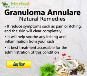 Skin Condition Granuloma Annulare Treatment