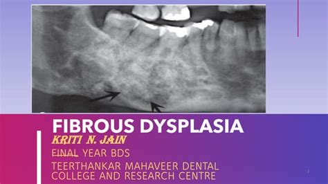 Fibrous Dysplasia Of Maxilla