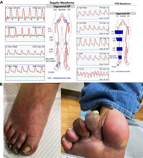 Noninvasive Vascular Testing And Patient Wound At Presentation A