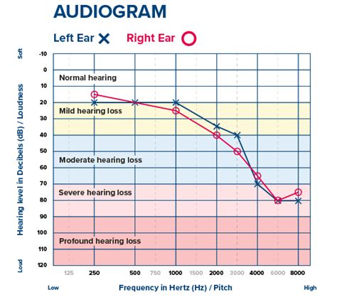 Degrees of hearing loss [Hearing loss chart]