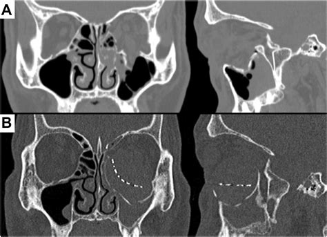 Concurrent Mucocele And Silent Sinus Syndrome After Orbital Fracture Repair Ophthalmology