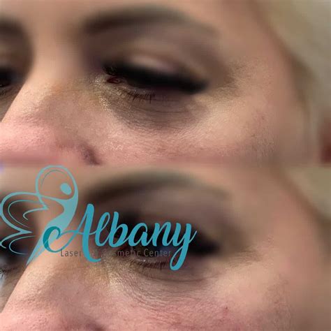 Tear Trough Fillers Albany Cosmetic And Laser Centre