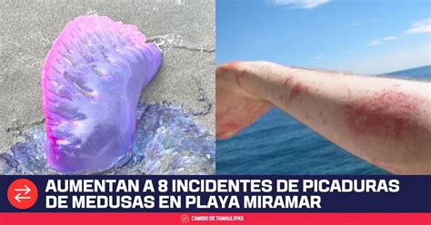 Aumenta A Incidentes Por Picaduras De Medusas En Playa Miramar