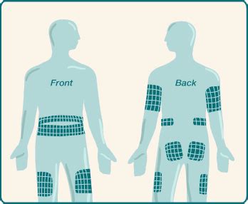 Rotating Insulin Injection Sites Diagrams