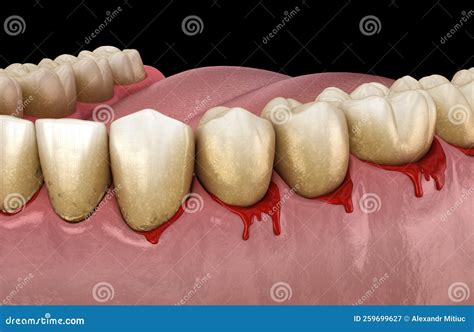 Bleeding Gums Or Periodontal Pathological Inflammatory Condition Of