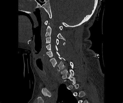 Differential Diagnosis Of Cervical Spine Injuries