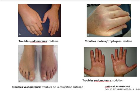 Algoneurodystrophie SDRC Syndrome douloureux régional complexe