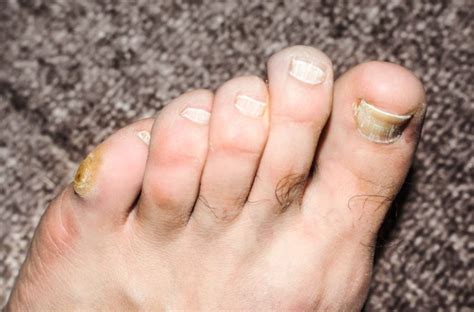 Hard Corn In Bone Below Pinky Toe Luxe Foot Surgery