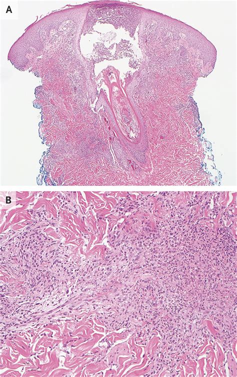 Case 7-2015 — A 25-Year-Old Man with Oral Ulcers, Rash, and Odynophagia | NEJM | Oral ulcer, 25 ...