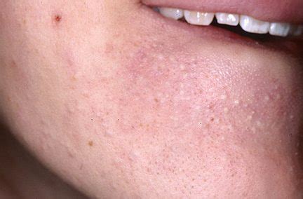 Skintherapy.. Ask the Esthetician: Whiteheads… are these pimples the opposite of blackheads?