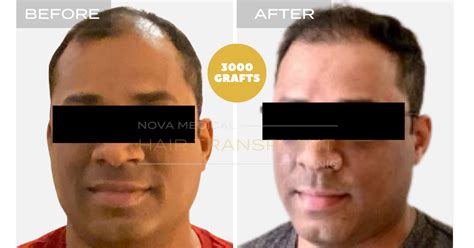 Gallery Nyc Hair Transplant Nova Medical