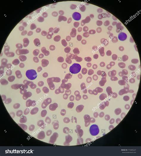 Promyelocyte