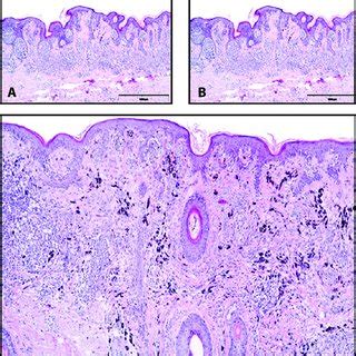 Histopathological Findings A Epidermal And Dermal Nests Of Common