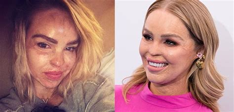 Katie Piper Before And After