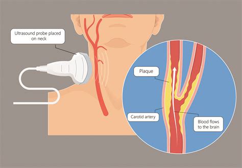 What Is Tcar Procedure Wellsmaineseafood