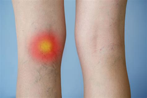 Can Varicose Veins Cause A Skin Rash