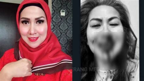 Foto Hidung Venna Melinda Bercucuran Darah Diduga Akibat KDRT