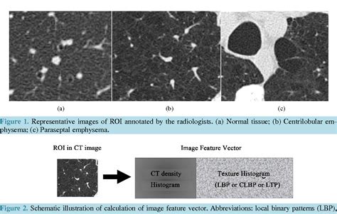 Figure 1 From Classification Of Emphysema Subtypes Comparative