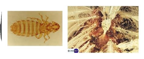 Session 6: Louse Infestations Flashcards | Quizlet