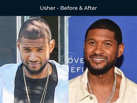 21 Black Celebrity Hair Transplants - Before & After Photos