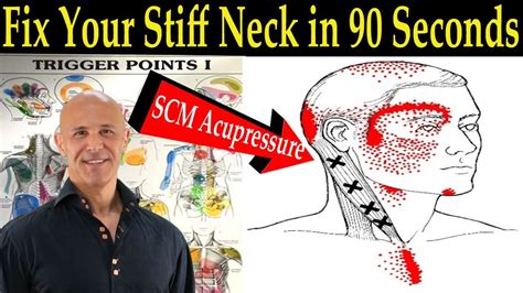 Sternocleidomastoid Trigger Points