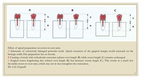 Ferrule Effect