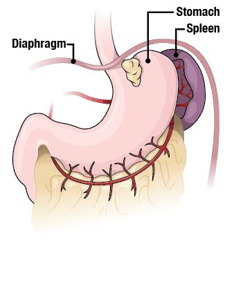 Pin on gastric sleeve Blossom Bariatric