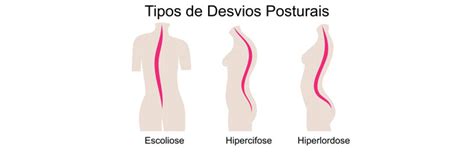 Tratamento De Desvios Posturais Atrav S De Exerc Cios F Sicos