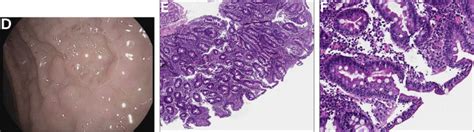 An Increasingly Uncommon Presentation Of A Common Disease Gastroenterology