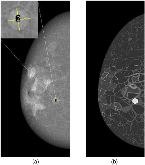 Tumor Size Measured In Simulated Mammograms For Evaluation Of The Tumor