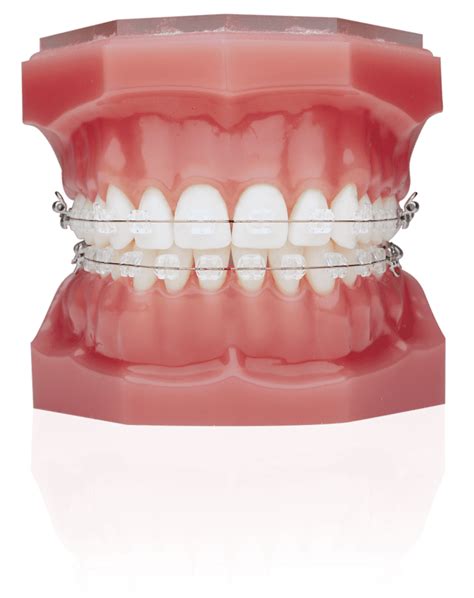 Ice Clear Ceramic Braces - The Look Orthodontics