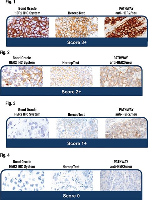 Scoring HER2 Expression Across The Full Spectrum CAP TODAY